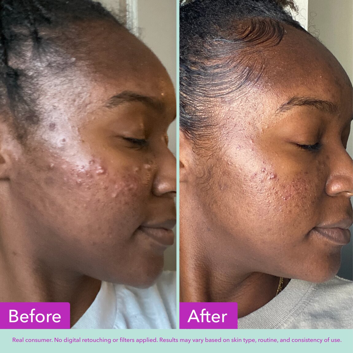 acne-foaming-cleanser-g1 zb_p.jpg
