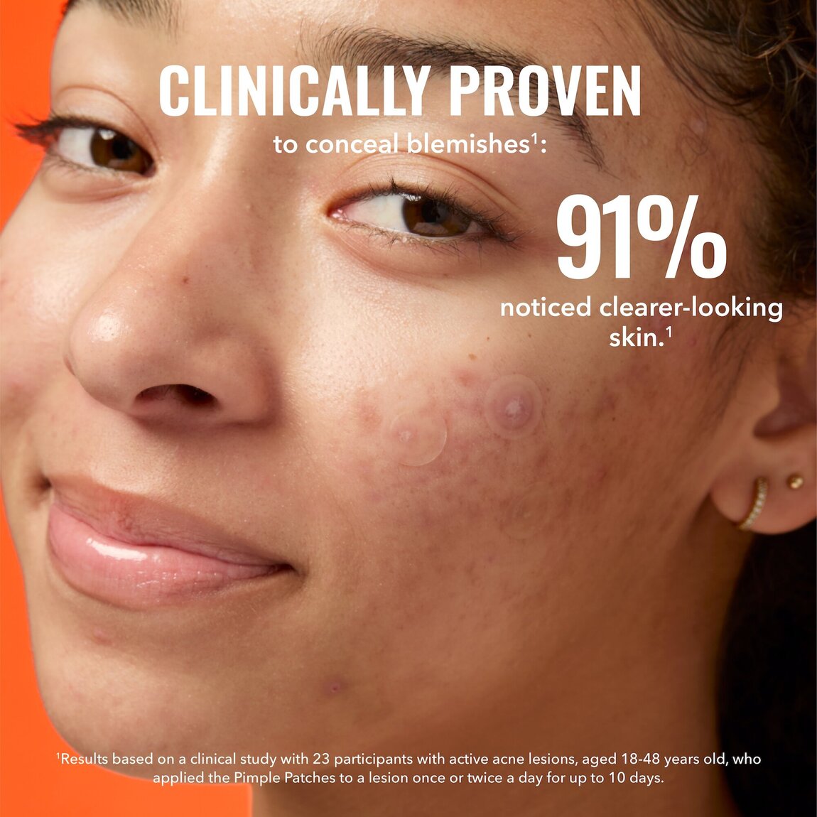 pimple-patches-a5 zb_p.jpg